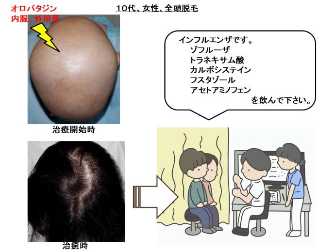 円形脱毛症　病院